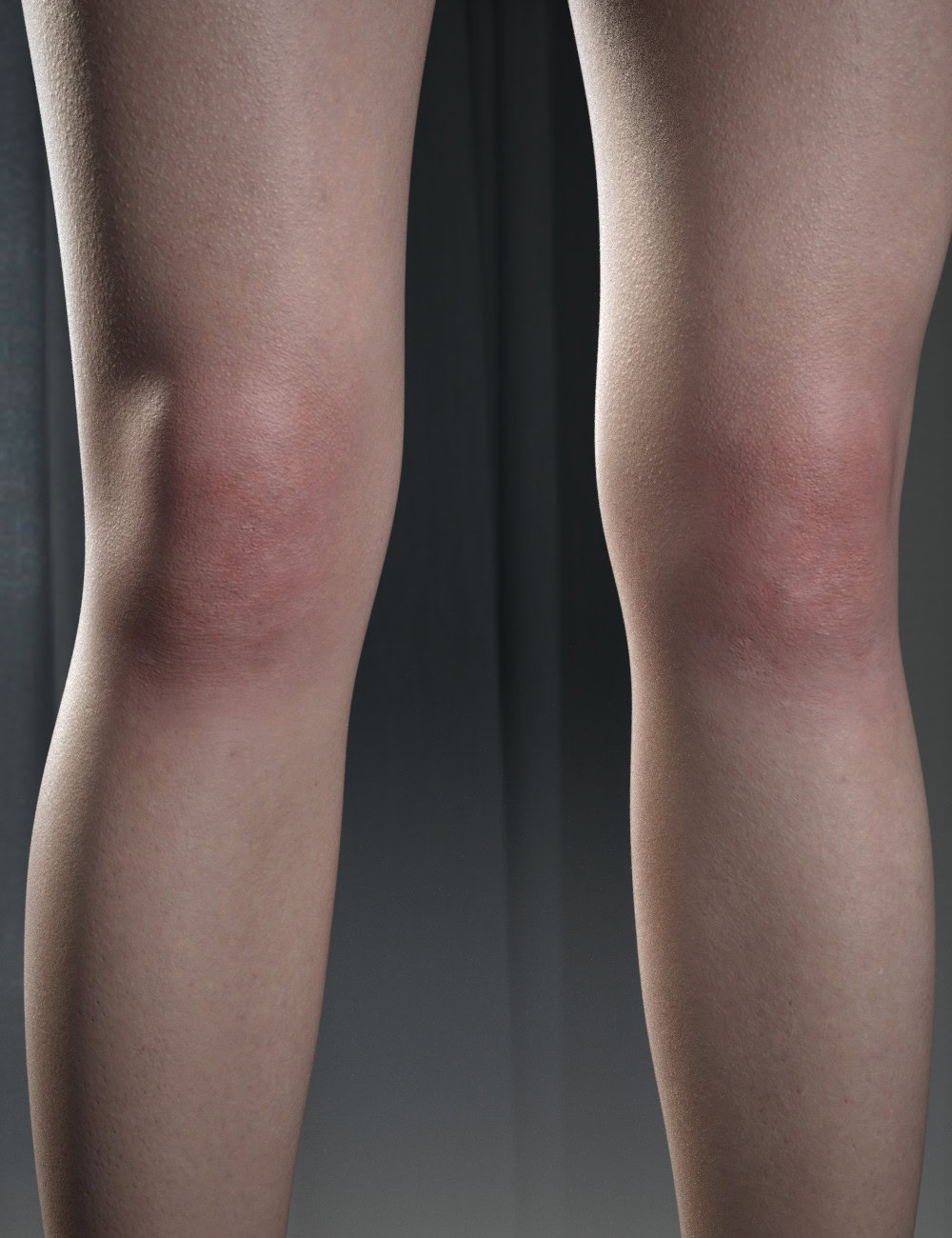 Close-up of red, swollen knees with purple bruising on the left knee.